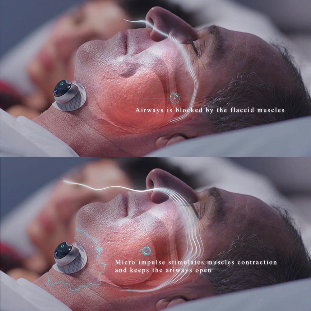 SleepWell - Smart Anti - Snoring Device - Luren Store